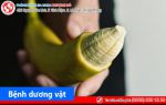Bệnh dương vật là gì? Cách chữa trị hiệu quả hiện nay