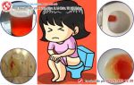 Đi tiểu ra máu ở nữ - đơn giản mà phức tạp