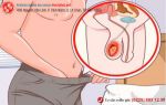 Nguyên nhân và cách điều trị nhức tinh hoàn