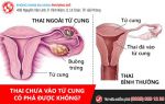 Thai chưa vào tử cung có phá được không? Giải đáp chi tiết từ bác sĩ chuyên khoa