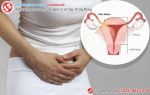 Viêm phần phụ là gì? Có nguy hiểm không?