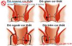 Các dạng rò hậu môn và cách điều trị hiện nay