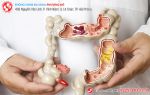 Tìm đúng phương pháp điều trị Polyp hậu môn tránh nguy cơ ung thư hậu môn