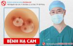 Hạ cam – căn bệnh tưởng lạ mà quen