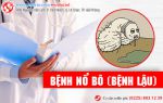 Bệnh nổ bô là gì? Phương pháp chữa bệnh nổ bô an toàn hiện nay