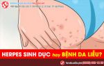 Herpes sinh dục – khác gì với bệnh da liễu thông thường?