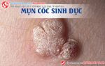 Nỗi ám ảnh mang tên mụn cóc sinh dục
