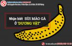 Nhận biết sớm các dấu hiệu sùi mào gà dương vật