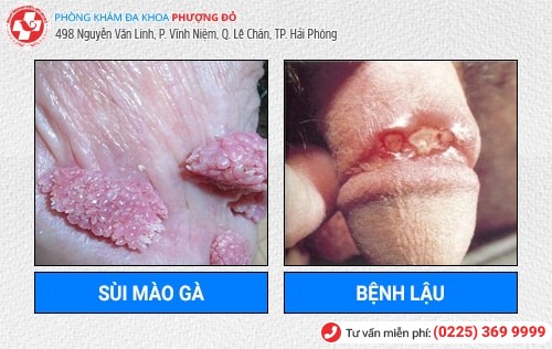 Bệnh Dương Vật Là Gì? Cách Chữa Trị Hiệu Quả Hiện Nay