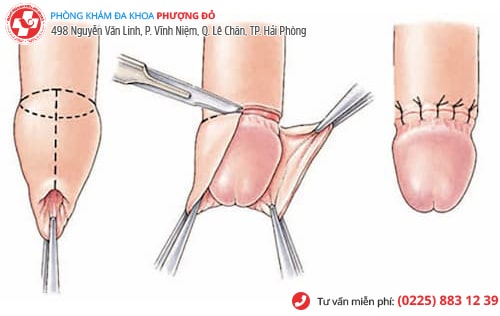 Hình ảnh bao quy đầu sau khi cắt