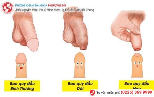 Bạn có chắc mình đã biết hết các bệnh về bao quy đầu?