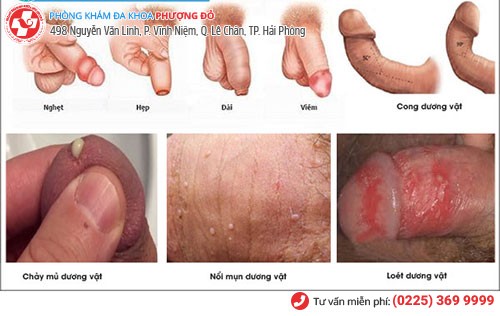 1 số bệnh dương vật thường gặp