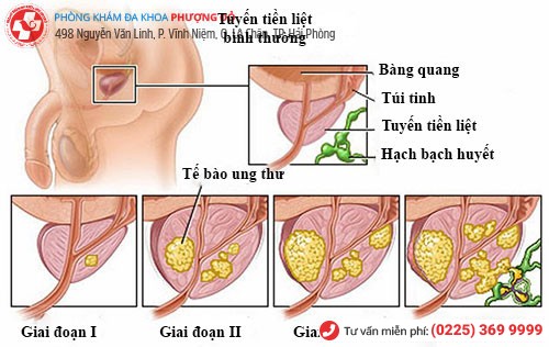 Ung thư tuyến tiền liệt - 1 dạng bệnh tuyến tiền liệt nguy hiểm