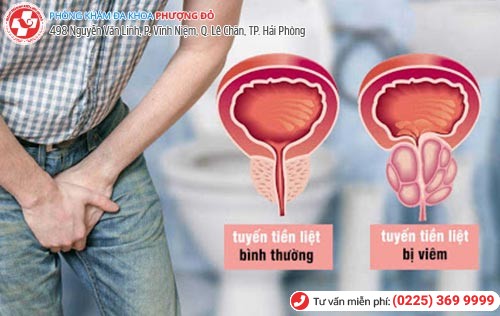 Viêm nam khoa là gì? Cách điều trị hiệu quả