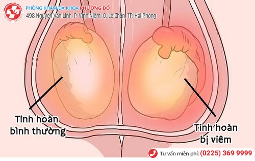 Hình ảnh tinh hoàn bị viêm