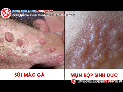 Mụn vùng kín do sùi mào gà, mụn rộp sinh dục