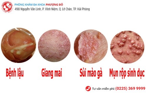 Các bệnh vùng kín ở nam giới không nên bỏ qua