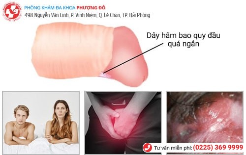 Dây hãm quy đầu bị ngắn có biểu hiện nào? Nguy hiểm không?