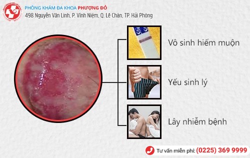 Viêm bao quy đầu là gì? Giải đáp chi tiết từ bác sĩ chuyên khoa