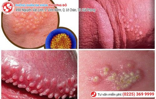 Đau rát bộ phận sinh dục - dấu hiệu nhiều bệnh nguy hiểm