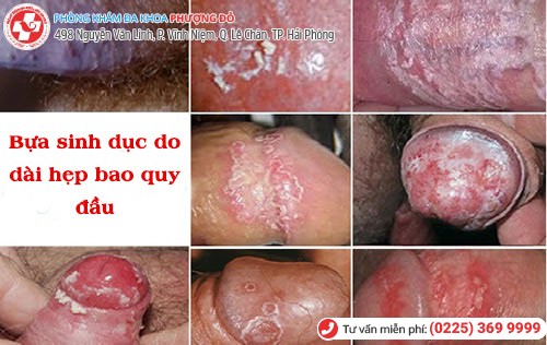 Bựa sinh dục – suýt hỏng dương vật vì lười vệ sinh