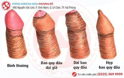 Các dạng cần cắt bao quy đầu