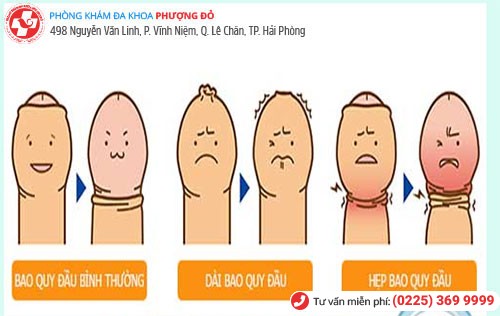 Dài, hẹp, nghẹt bao quy đầu cần lột bao quy đầu sớm