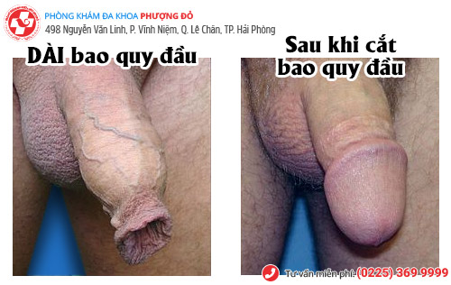 hình ảnh sau khi cắt bao quy đầu dài