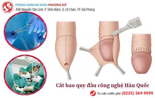 Phương pháp cắt bao quy đầu công nghệ xâm lấn tối thiểu Hàn Quốc