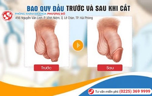 So sánh hình ảnh trước và sau khi cắt bao quy đầu