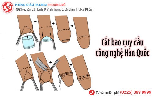 Cách mở bao quy đầu