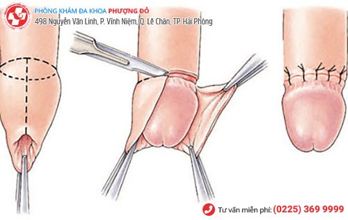 Cắt bao quy đầu công nghệ xâm lấn tối thiểu Hàn Quốc