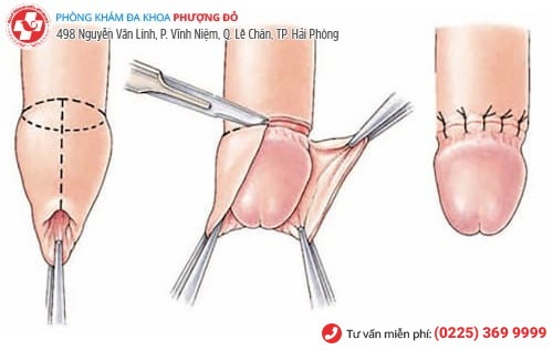 Phương pháp tiểu phẫu cắt bao quy đầu công nghệ xâm lấn tối thiểu Hàn Quốc