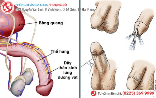 Chữa trầy xước bao quy đầu