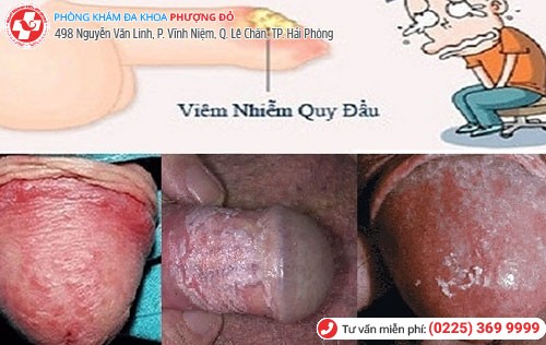 Hình ảnh bao quy đầu bị viêm