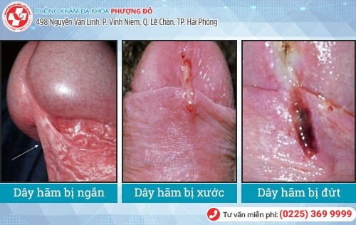 Tổng quan dây hãm bao quy đầu nam giới nên biết