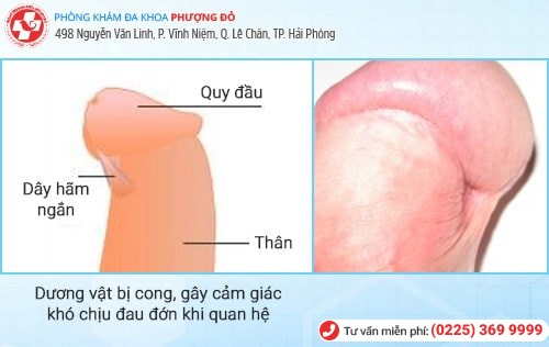 Dây hãm quy đầu bị ngắn có biểu hiện nào? Nguy hiểm không?