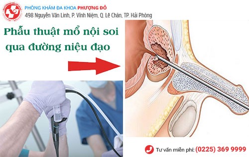 Phẫu thuật mổ nộ soi phì đại tuyến tiền liệt mang lại hiệu quả nhất hiện nay