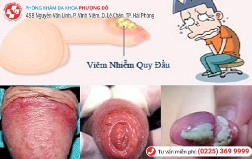 Hình ảnh dương vật có cặn trắng do viêm bao quy đầu