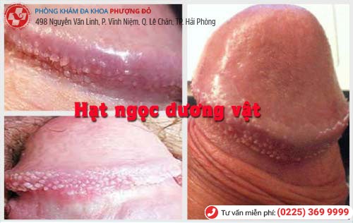 Hình ảnh chuỗi hạt ngọc dương vật