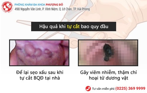 Cắt bao quy đầu tại nhà có được không?