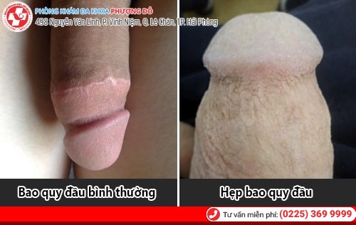 Hẹp bao quy đầu là gì? Cách chữa hẹp bao quy đầu hiệu quả