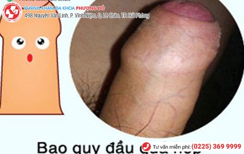 Dấu hiệu hẹp bao quy đầu