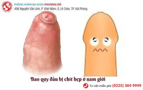 Bao quy đầu không tụ tuột được do hẹp bao quy đầu