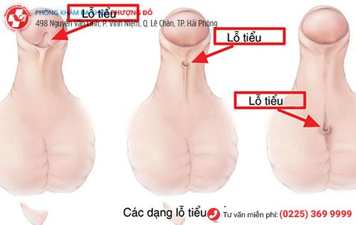 Hẹp lỗ tiểu do bẩm sinh