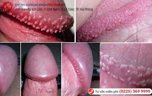 Chuỗi hạt ngọc dương vật