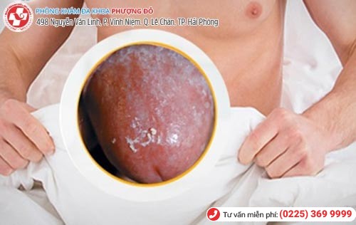 Dài, hẹp, viêm bao quy đầu nên tiểu phẫu cắt bao quy đầu sớm