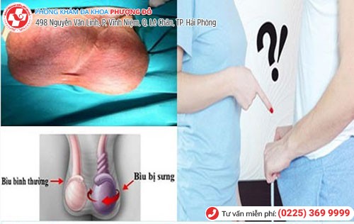 Hình ảnh tinh hoàn bị xoắn