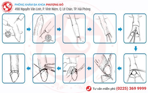 Kỹ thuật xâm lấn tối thiểu cắt bao quy đầu