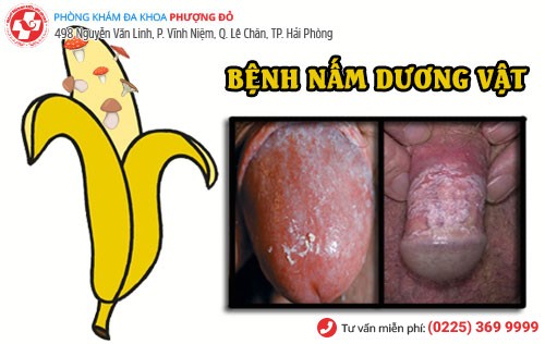 Bệnh nấm dương vật